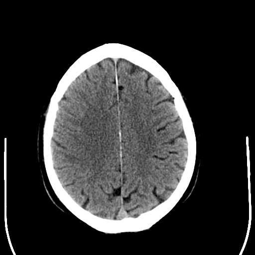 File:Anaplastic meningioma with recurrence (Radiopaedia 34452-35781 Axial non-contrast 24).png