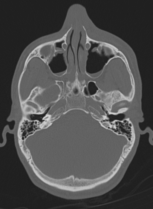 Anaplastic oligodendroglioma with skull fracture (Radiopaedia 74831-85846 Axial bone window 62).png