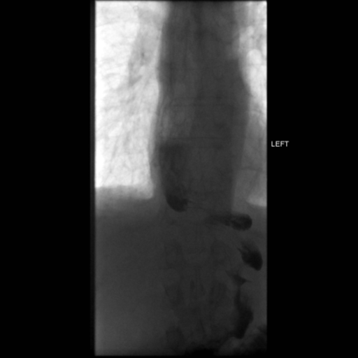 File:Anastomotic stricture post Ivor Lewis esophagectomy (Radiopaedia 47937-52715 C 22).png