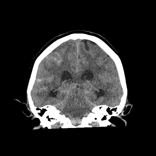 Aneursym related subarachnoid hemorrhage with hydrocephalus (Radiopaedia 45105-49083 Coronal non-contrast 40).jpg
