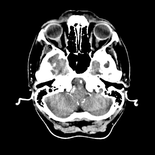 Aneursym related subarachnoid hemorrhage with hydrocephalus (Radiopaedia 45105-49084 D 9).jpg