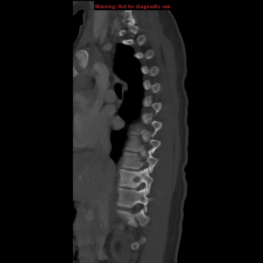 File:Aneurysmal bone cyst (Radiopaedia 9419-10102 Sagittal bone window 2).jpg