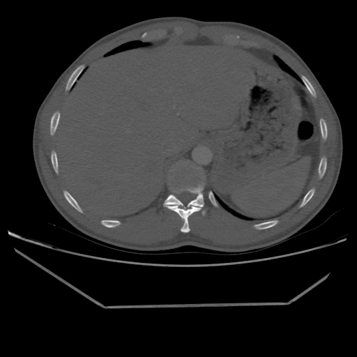 Aneurysmal bone cyst - rib (Radiopaedia 82167-96220 Axial bone window 224).jpg