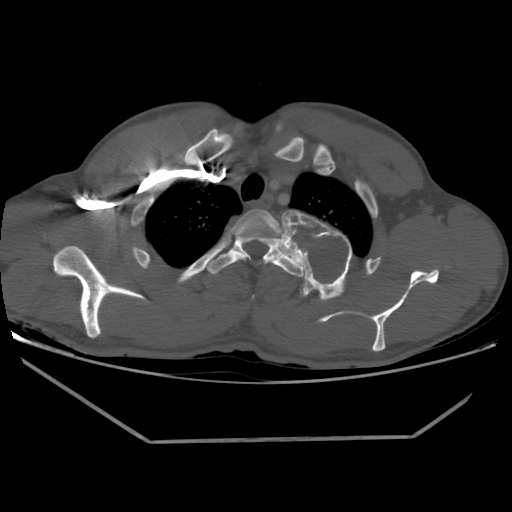 Aneurysmal bone cyst - rib (Radiopaedia 82167-96220 Axial bone window 64).jpg