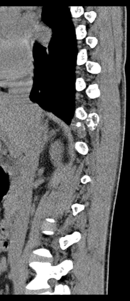 Aneurysmal bone cyst T11 (Radiopaedia 29294-29721 E 56).jpg