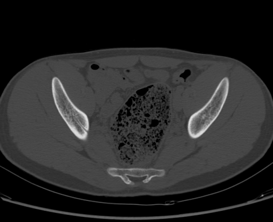 File:Aneurysmal bone cyst of ischium (Radiopaedia 25957-26094 Axial bone window 38).png