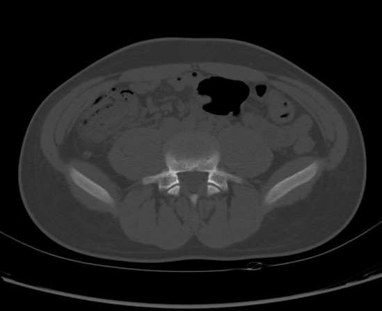 File:Aneurysmal bone cyst of ischium (Radiopaedia 25957-26094 Axial bone window 8).png