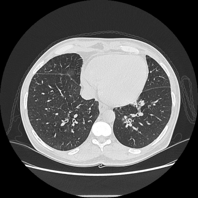 Angioinvasive aspergellosis (Radiopaedia 66995-76315 Axial lung window 37).jpg