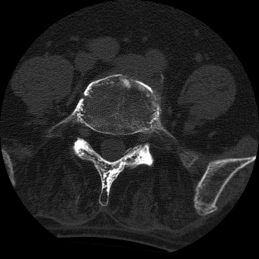 Ankylosing spondylitis complicated by fracture-dislocation (Radiopaedia 33583-34674 Axial non-contrast 129).jpg