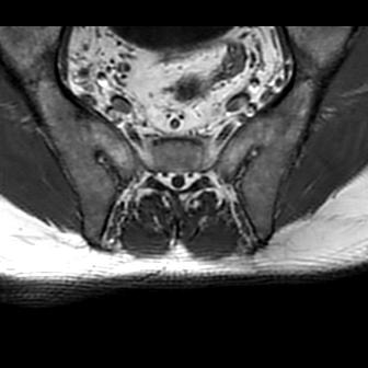 File:Ankylosing spondylitis with zygapophyseal arthritis (Radiopaedia 38433-40517 B 7).jpg