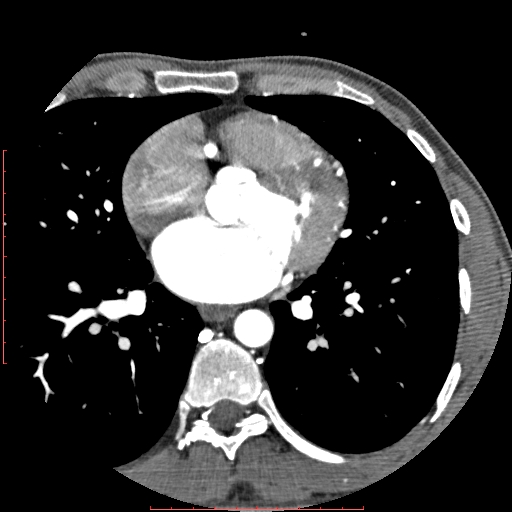 Anomalous left coronary artery from the pulmonary artery (ALCAPA) (Radiopaedia 70148-80181 A 163).jpg