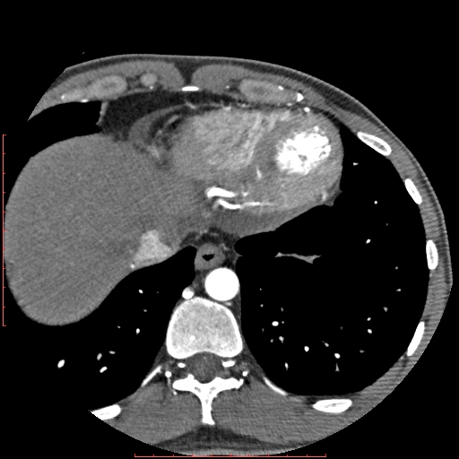 File:Anomalous left coronary artery from the pulmonary artery (ALCAPA) (Radiopaedia 70148-80181 A 342).jpg