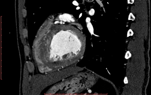 File:Anomalous left coronary artery from the pulmonary artery (ALCAPA) (Radiopaedia 70148-80181 C 177).jpg