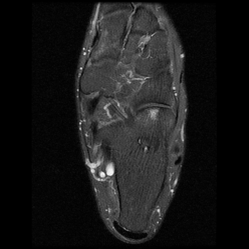 File:Anterior calcaneal process fracture (Radiopaedia 74654-85611 Axial PD fat sat 17).jpg