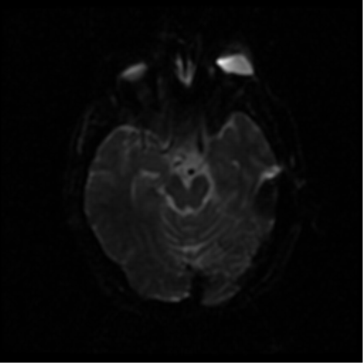 File:Anterior cerebral artery territory infarct (Radiopaedia 39327-41584 Axial DWI 34).png