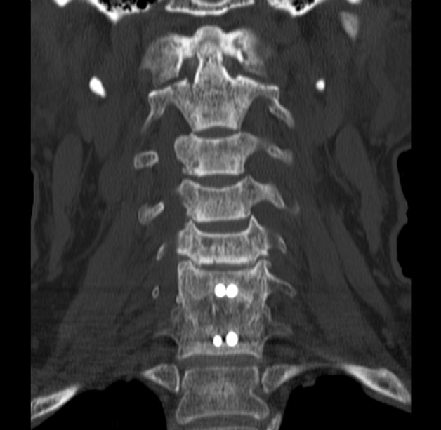 Anterior cervical postdiscectomy arthrodesis (Radiopaedia 32678-33646 Coronal bone window 22).jpg