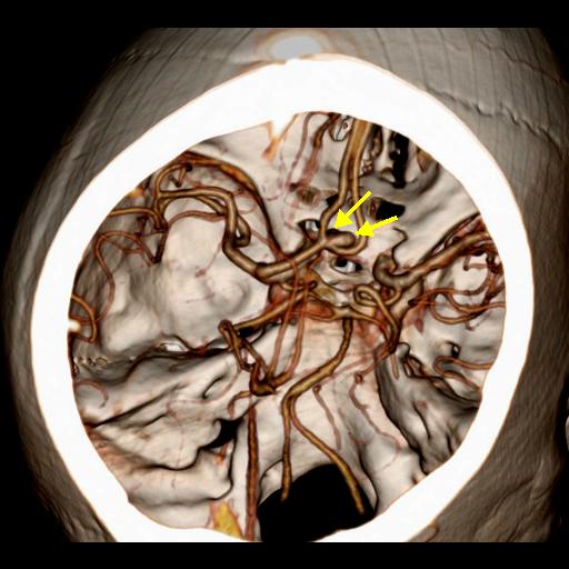 File:Anterior communicating artery aneurysm (Radiopaedia 16633-16335 F 1).jpg