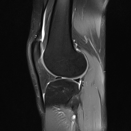 File:Anterior cruciate ligament full thickness tear (Radiopaedia 66268-75467 Sagittal PD fat sat 17).jpg