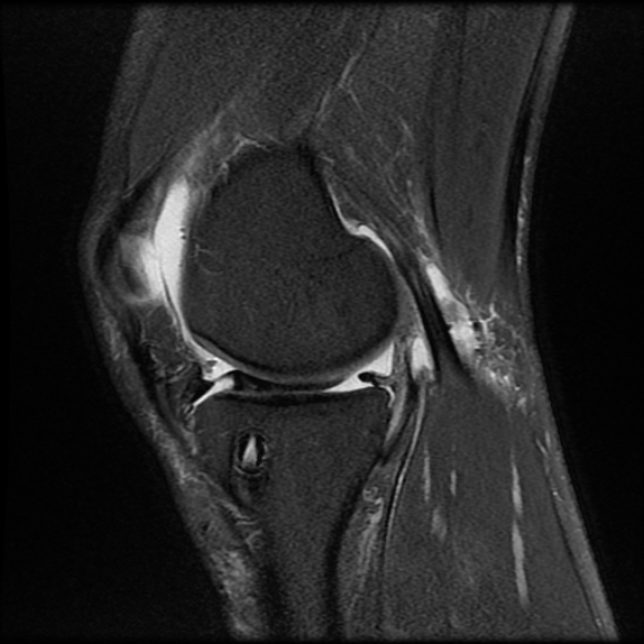 File:Anterior cruciate ligament graft tear and bucket-handle tear of medial meniscus (Radiopaedia 75867-87255 Sagittal PD fat sat 9).jpg