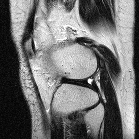 File:Anterior cruciate ligament mucoid degeneration (Radiopaedia 60853-68633 Sagittal T2 22).jpg