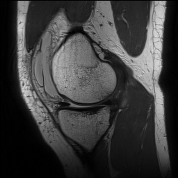 Anterior cruciate ligament rupture with Segond fracture (Radiopaedia 69043-78806 Sagittal PD 61).jpg