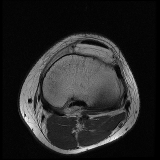 File:Anterior cruciate ligament tear (Radiopaedia 61500-69462 Axial PD 16).jpg