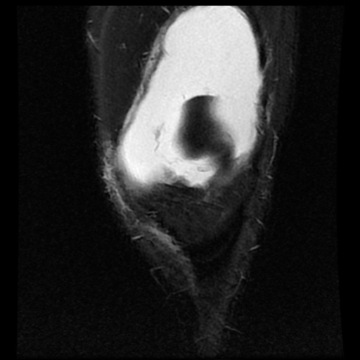 File:Anterior cruciate ligament tear (Radiopaedia 61500-69462 Coronal STIR 4).jpg