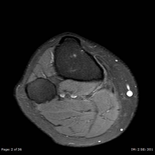 File:Anterior cruciate ligament tear (Radiopaedia 70783-80964 Axial PD fat sat 2).jpg