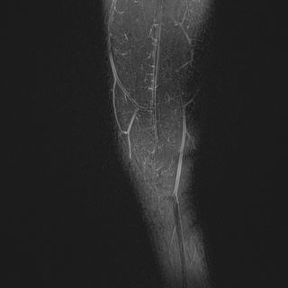 File:Anterior cruciate ligament tear - pediatric (Radiopaedia 62152-70260 Sagittal PD fat sat 3).jpg