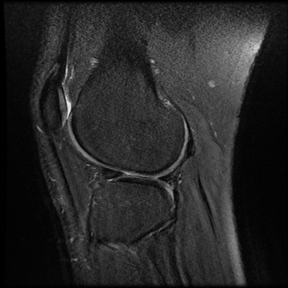 File:Anterior cruciate ligament tear with posteromedial corner injury, bucket-handle meniscal tear and chondral delamination (Radiopaedia 75501-86744 Sagittal PD fat sat 21).jpg