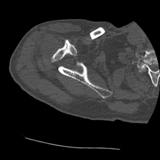 Anterior glenohumeral dislocation with Hill-Sachs lesion (Radiopaedia 62877-71249 Axial bone window 24).jpg