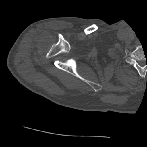 Anterior glenohumeral dislocation with Hill-Sachs lesion (Radiopaedia 62877-71249 Axial bone window 25).jpg