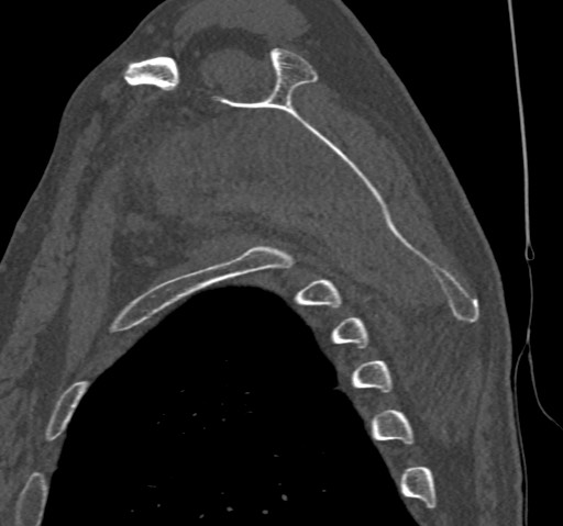 Anterior glenohumeral dislocation with Hill-Sachs lesion (Radiopaedia 62877-71249 Sagittal bone window 45).jpg