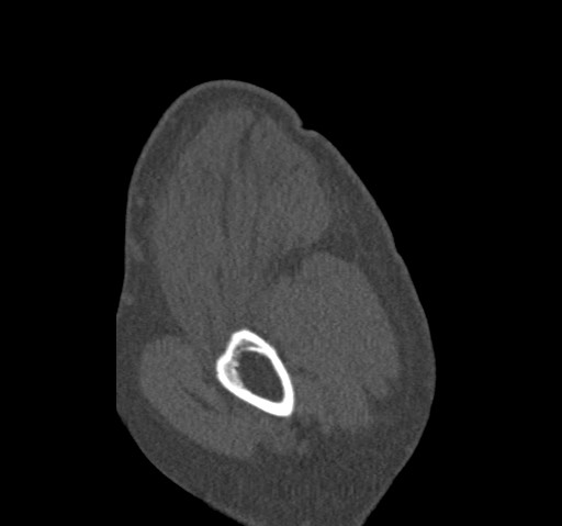 Anterior glenohumeral dislocation with Hill-Sachs lesion (Radiopaedia 62877-71249 Sagittal bone window 9).jpg
