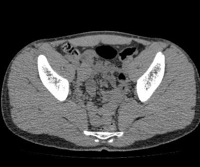 Anterior inferior iliac spine avulsion fracture (Radiopaedia 81312-94999 Axial non-contrast 42).jpg