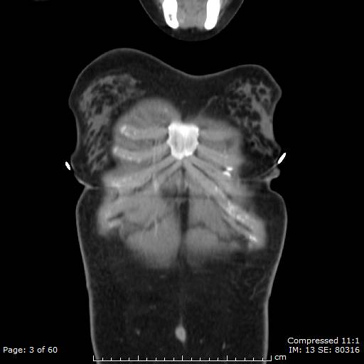 File:Anterior mediastinal B cell Lymphoma (Radiopaedia 50677-56114 B 2).jpg