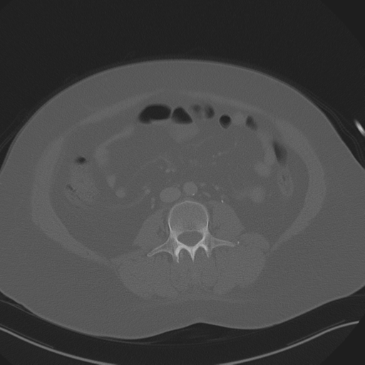 Anterior superior iliac spine avulsion fracture (Radiopaedia 44541-48244 Axial bone window 54).png