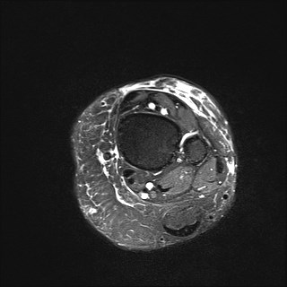 File:Anterior talofibular ligament injury - rupture with soft-tissue impingement (Radiopaedia 38765-40928 Axial T2 fat sat 4).jpg