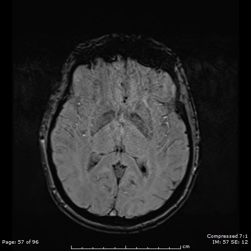 Anterior temporal lobe perivascular space (Radiopaedia 88283-104914 Axial SWI 26).jpg