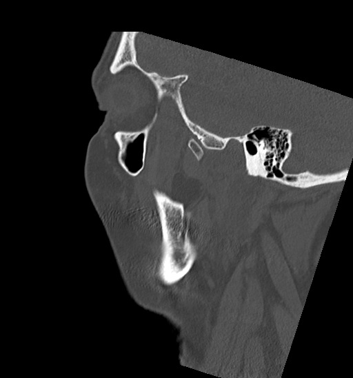 Anterior temporomandibular joint dislocation (Radiopaedia 59430-66784 B 11).jpg