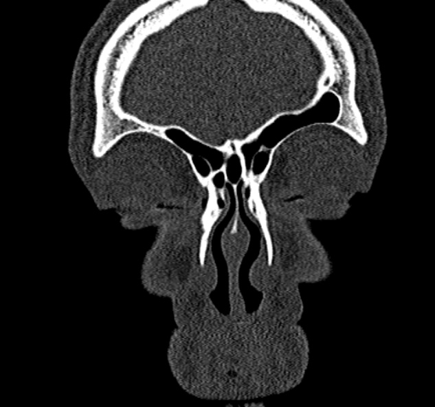 File:Antrochoanal polyp (Radiopaedia 30002-30554 Coronal bone window 17).jpg