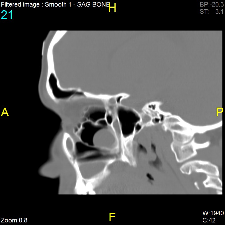 Antrochoanal polyp (Radiopaedia 65101-74094 Sagittal bone window 21).jpg