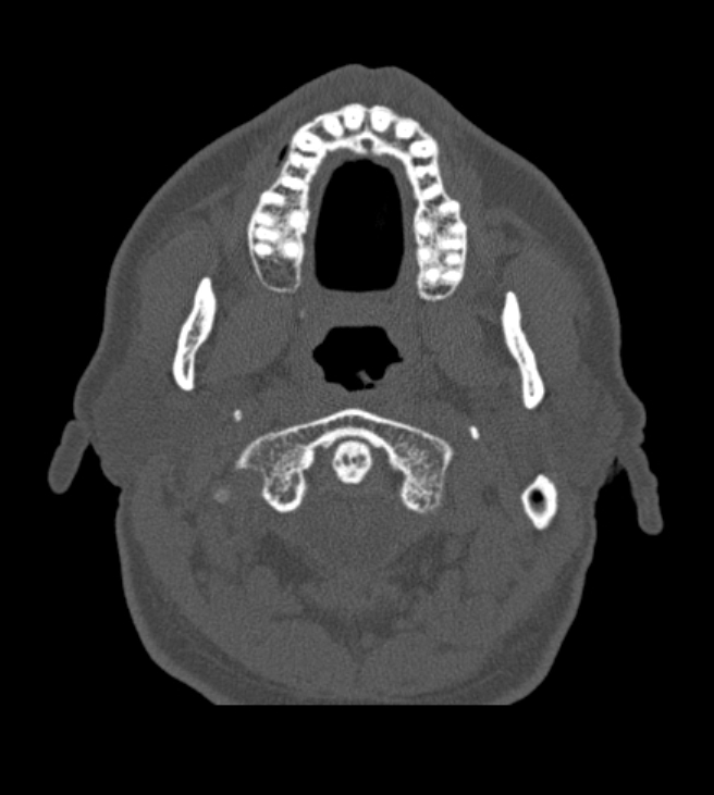 Antrochoanal polyp (Radiopaedia 79011-92169 Axial bone window 2).jpg