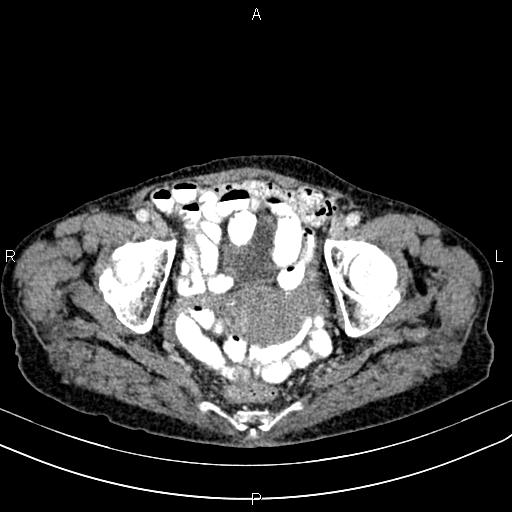 File:Aortic aneurysm and Lemmel syndrome (Radiopaedia 86499-102554 A 72).jpg