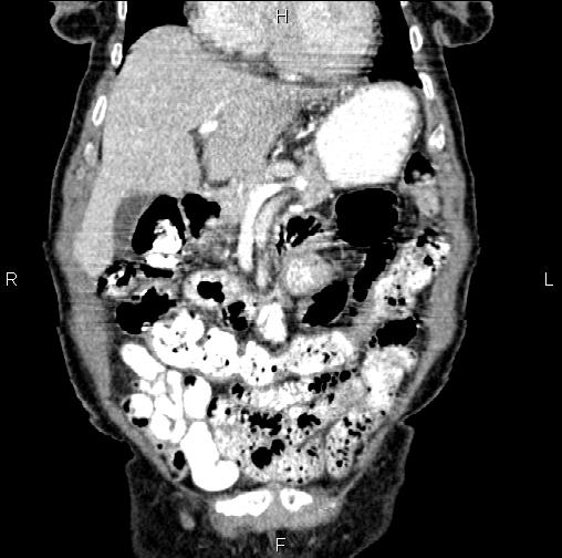 Aortic aneurysm and Lemmel syndrome (Radiopaedia 86499-102554 C 16).jpg