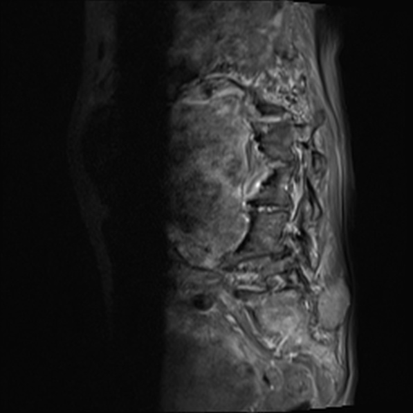 File:Aortic aneurysm with spinal destruction (Radiopaedia 42301-45409 Sagittal T1 fat sat 31).jpg