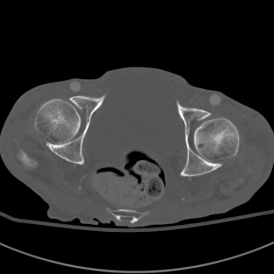 Aortic aneurysm with spinal destruction (Radiopaedia 42301-45410 Axial bone window 105).jpg
