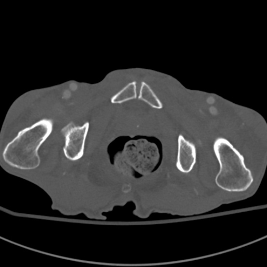 Aortic aneurysm with spinal destruction (Radiopaedia 42301-45410 Axial bone window 116).jpg
