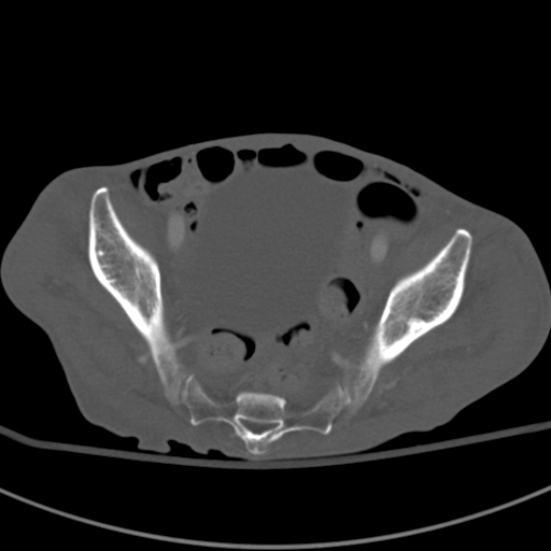 Aortic aneurysm with spinal destruction (Radiopaedia 42301-45410 Axial bone window 92).jpg