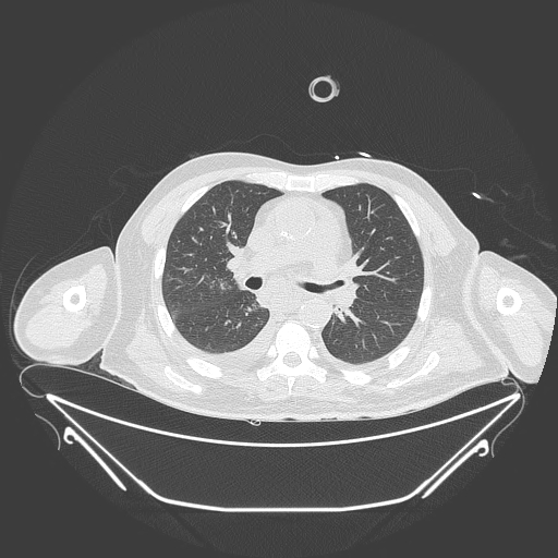Aortic arch aneurysm (Radiopaedia 84109-99365 Axial lung window 131).jpg